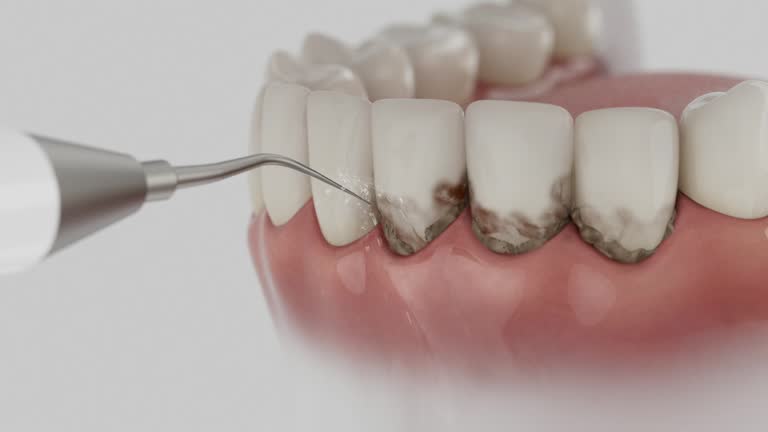 Trusted Wisdom Tooth Removal service in Madisonville, KY - Dentist Open Now
